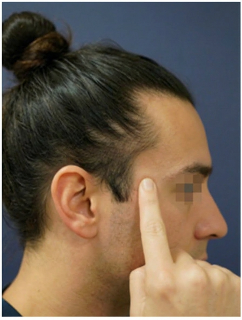 Temporal trigger point