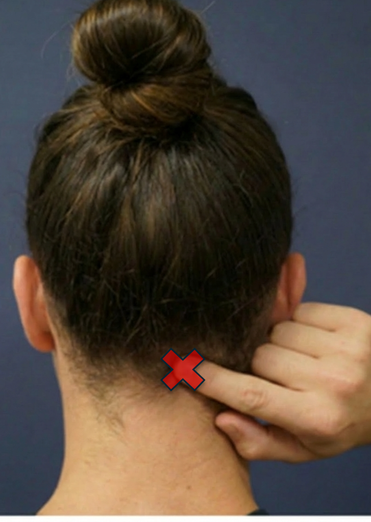 Occipital Migraine View 1